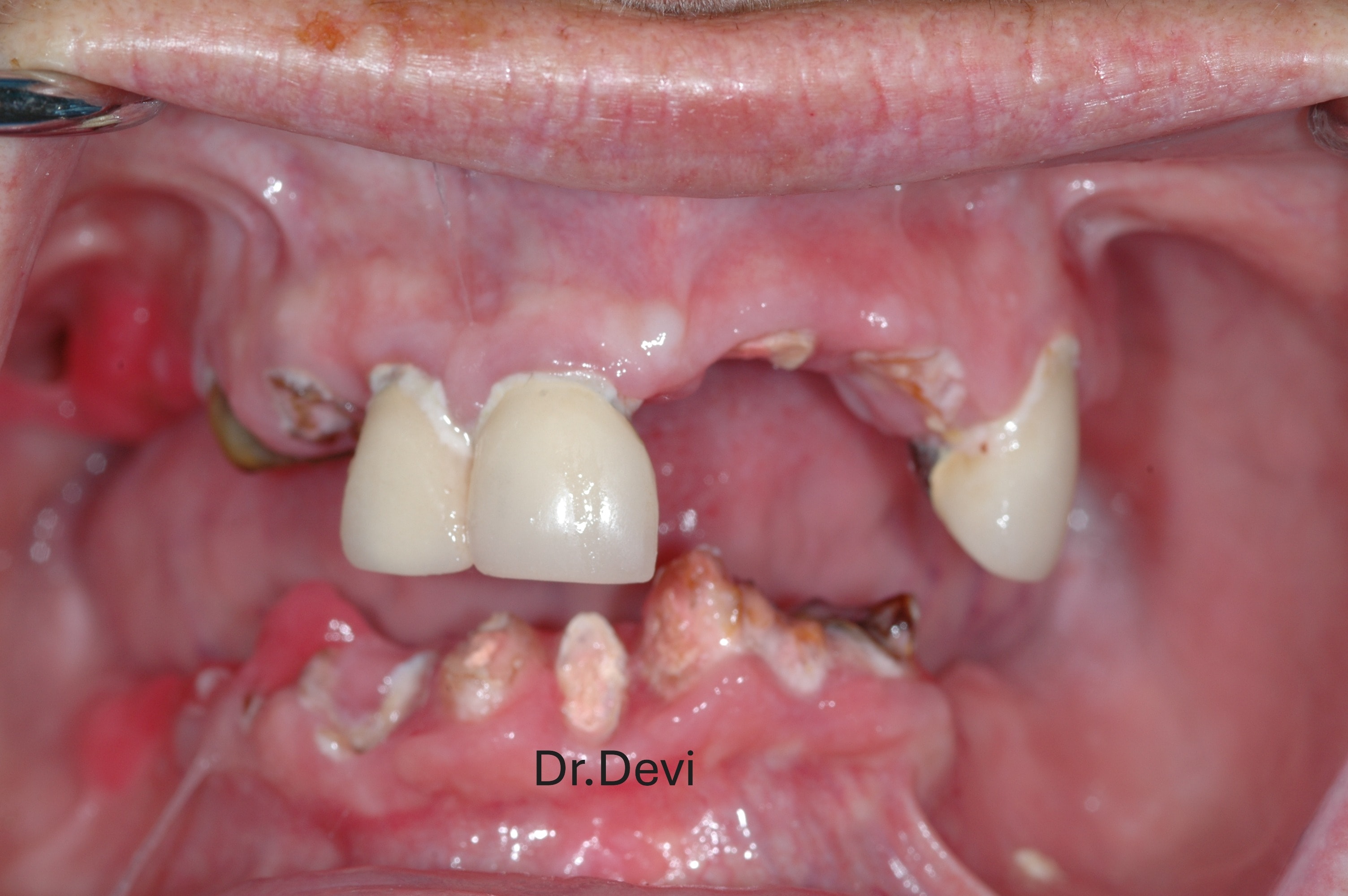 All-on-4 full arch smile result