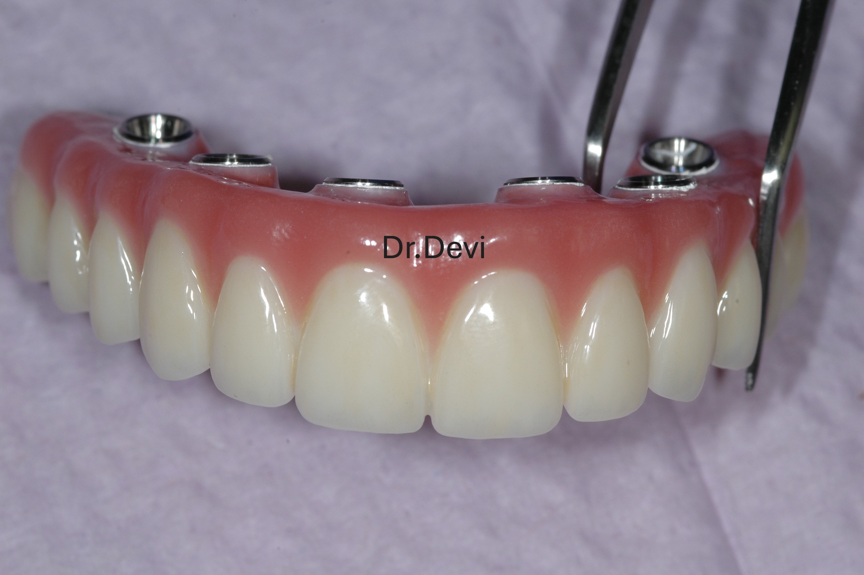Full arch dental implant restoration