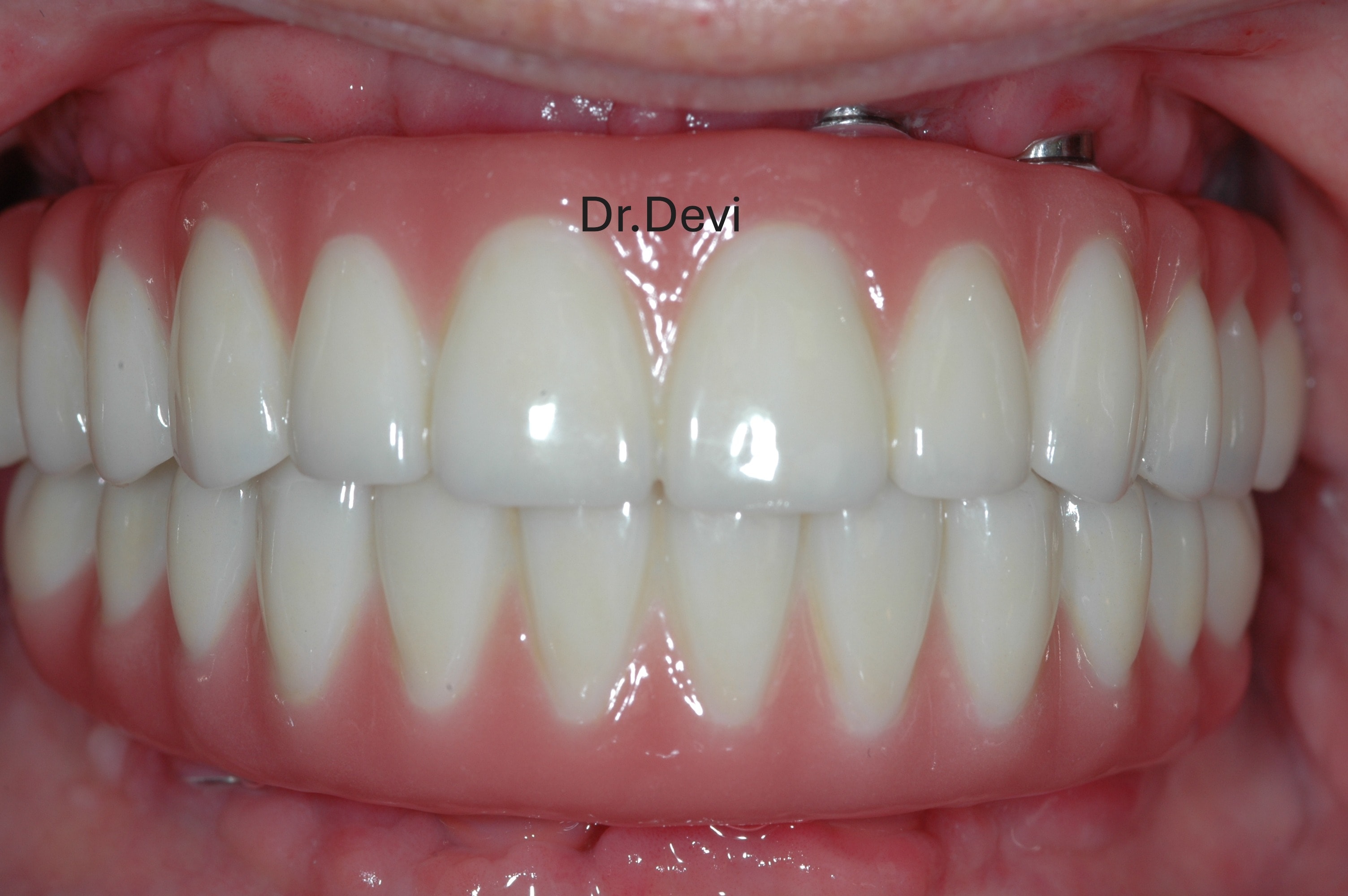 Patient new smile transformation