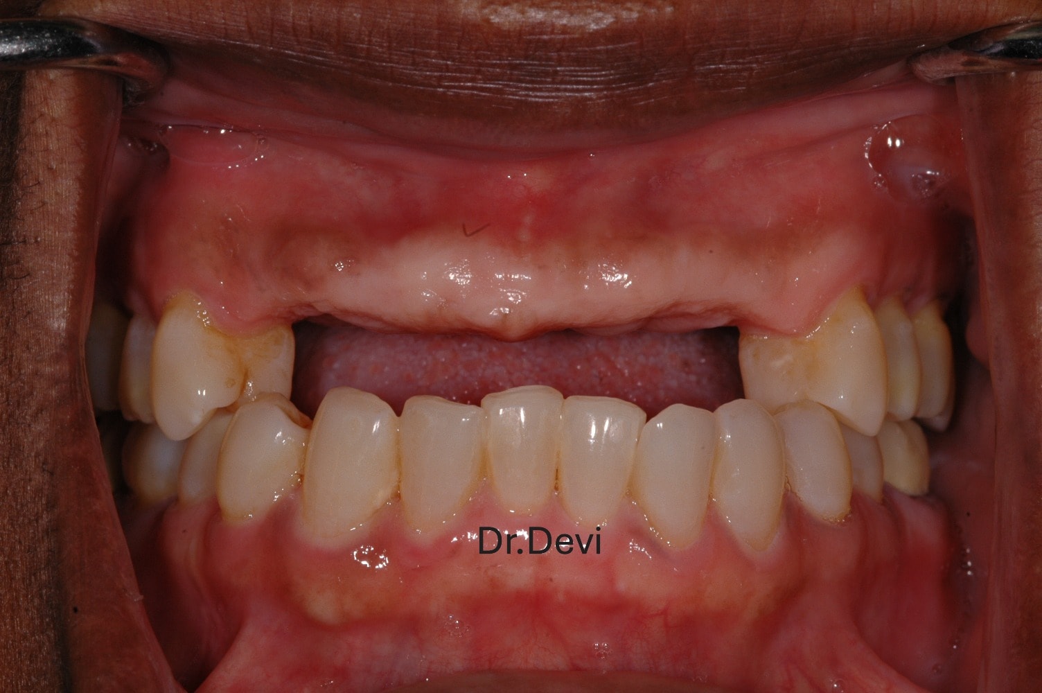 Dental implant smile result