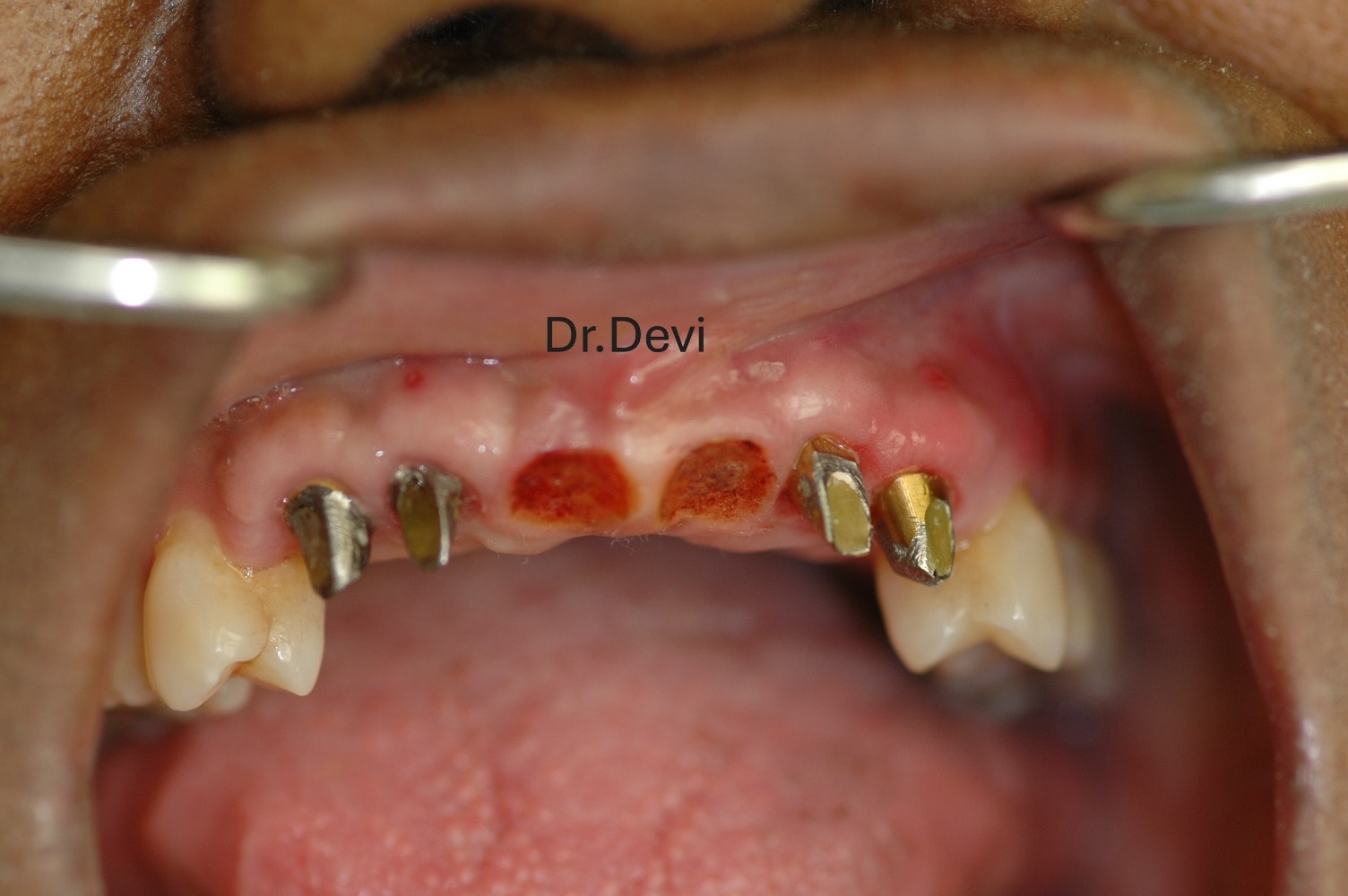 Dental prosthetic restoration