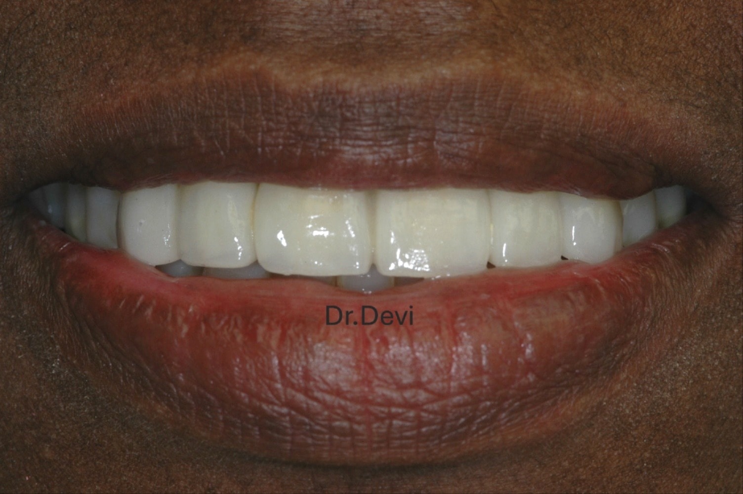 Beautiful smile dental result