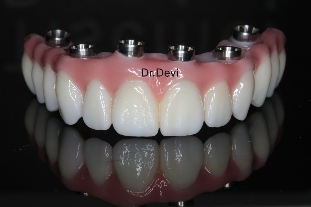 Implant bridge dental restoration