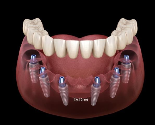 Dental implant procedure