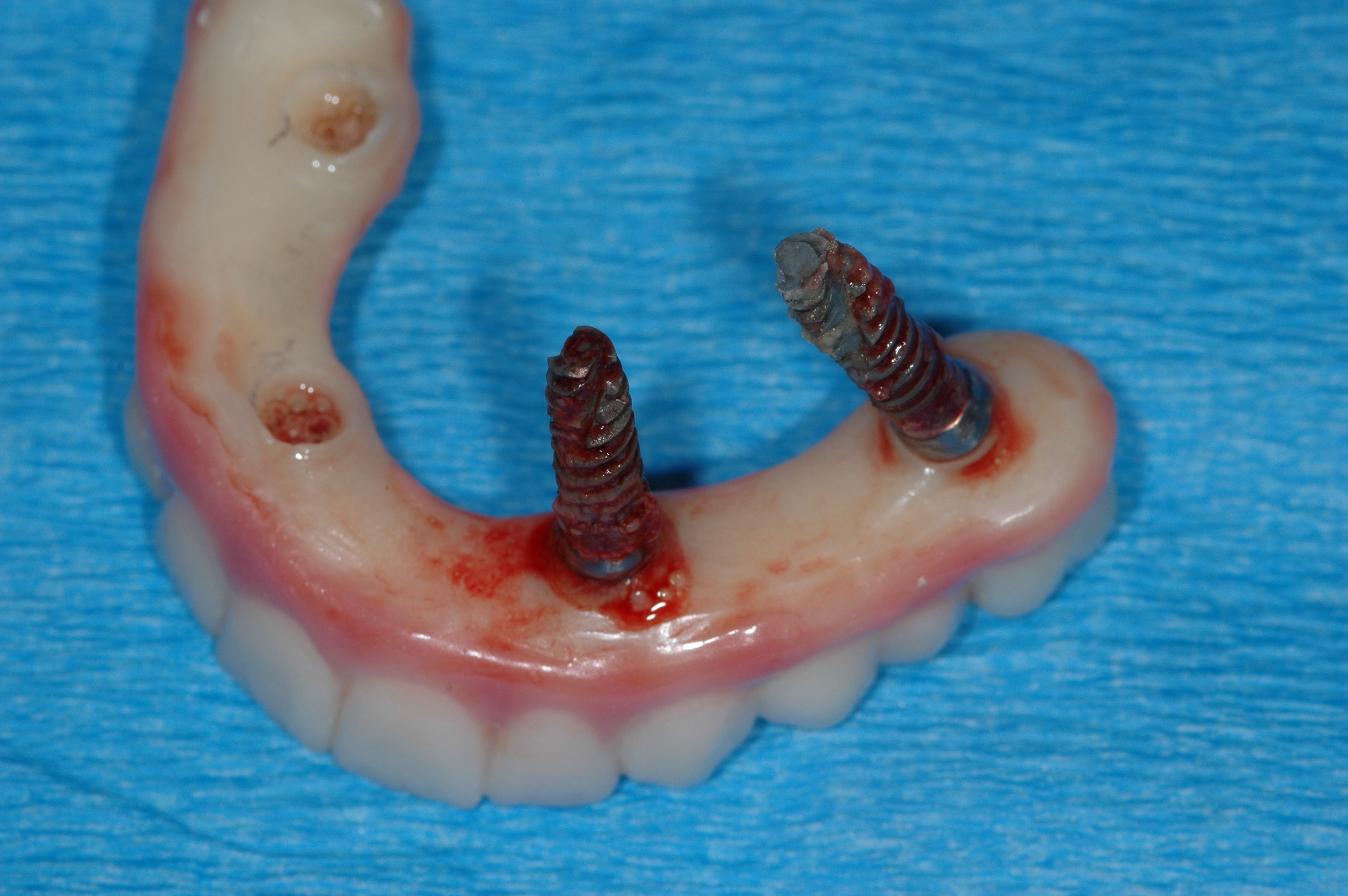 Panoramic X-ray showing implant bone loss