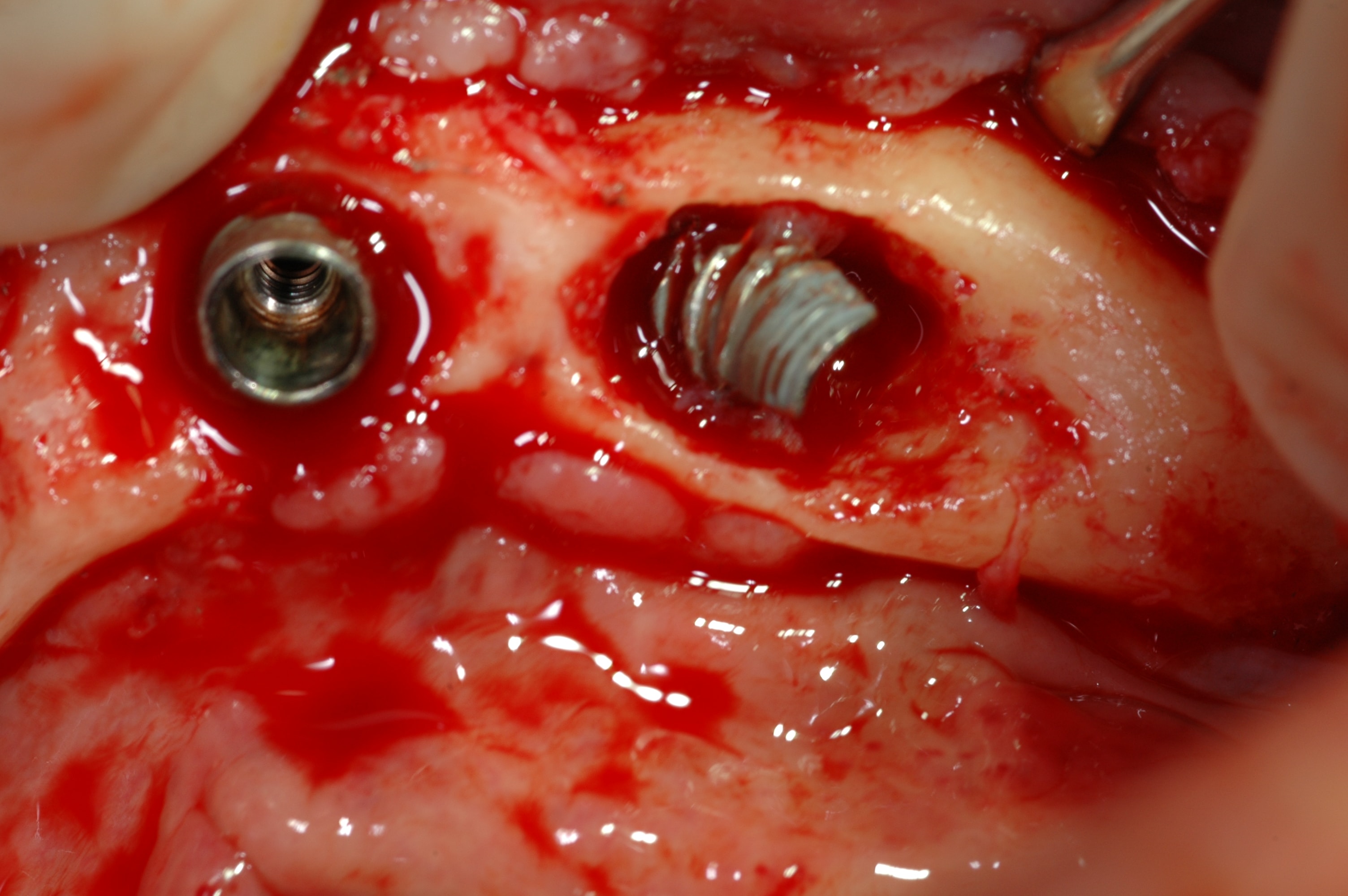 Poor quality dental restoration