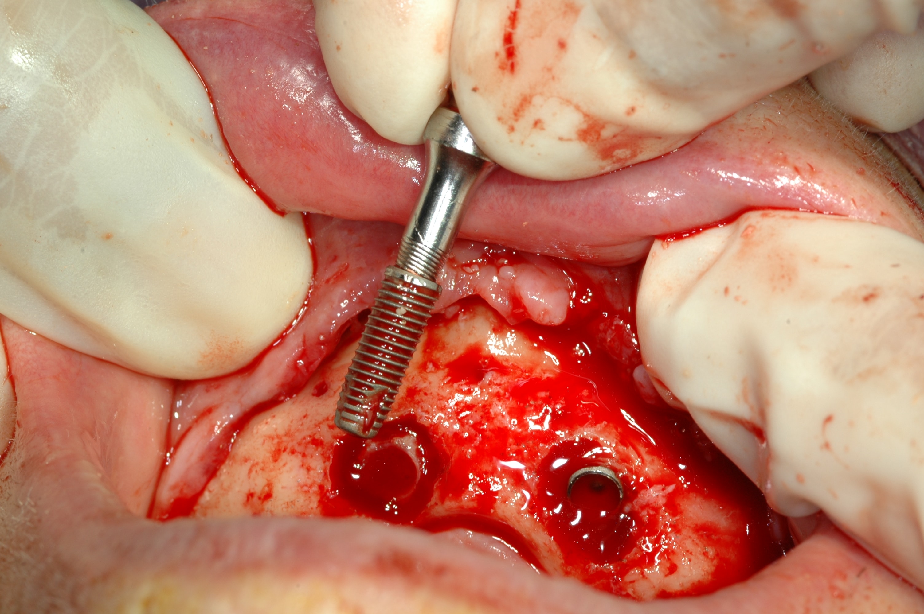 Implant removed due to failure