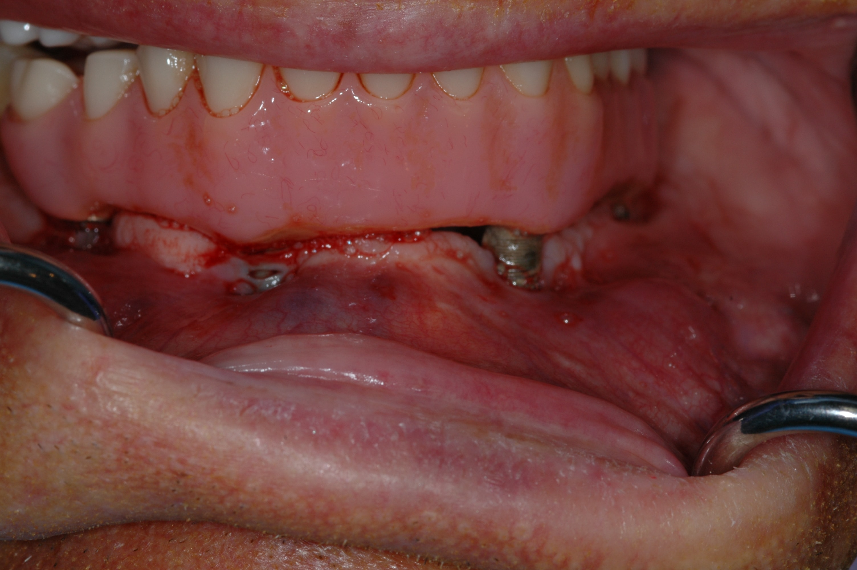 Failing implants with tissue inflammation