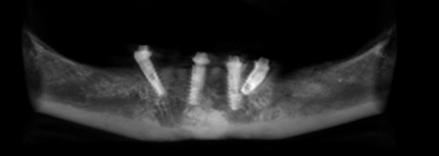 X-ray showing implants placed at wrong angles