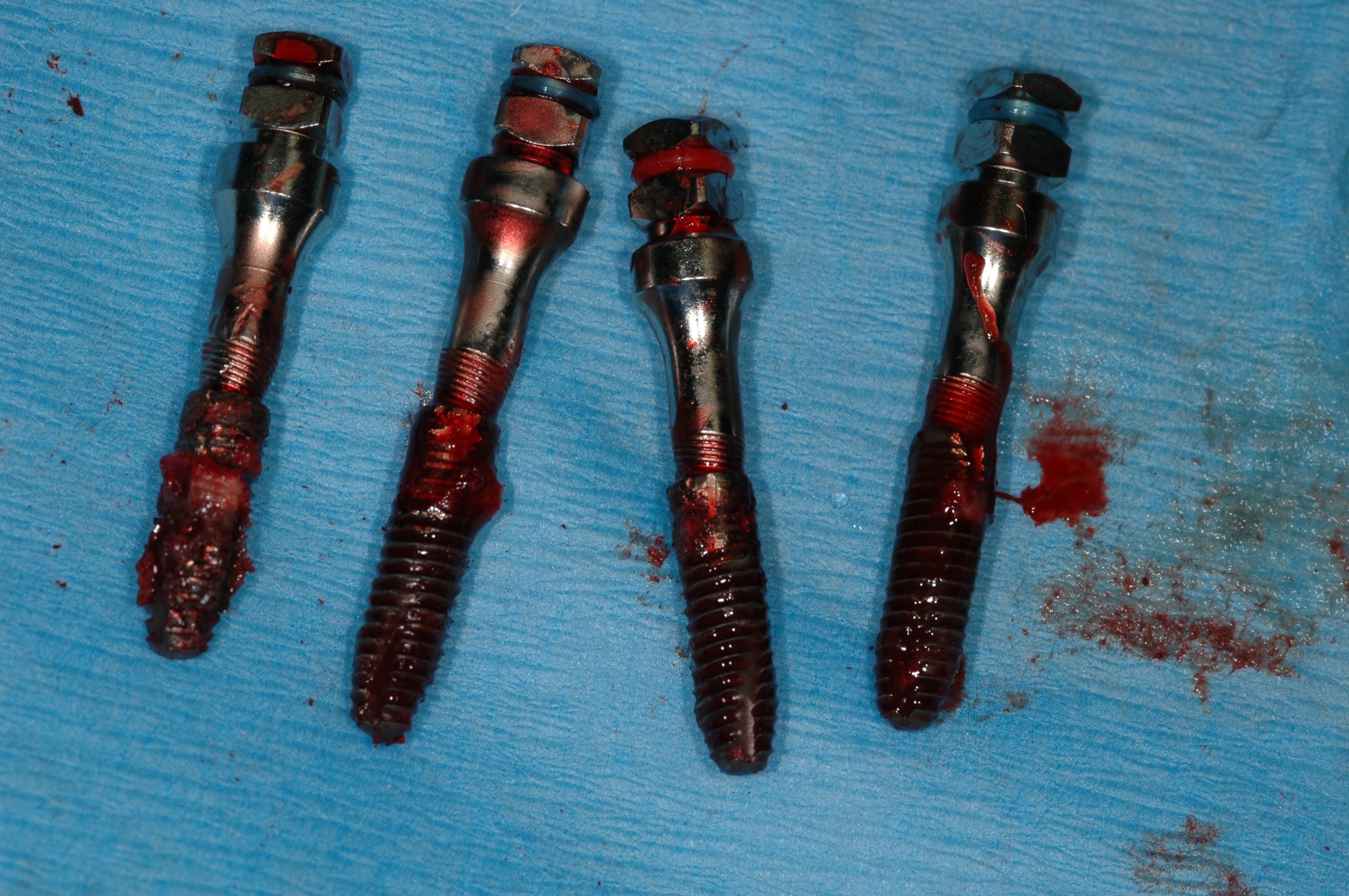 Broken fractured dental prosthesis