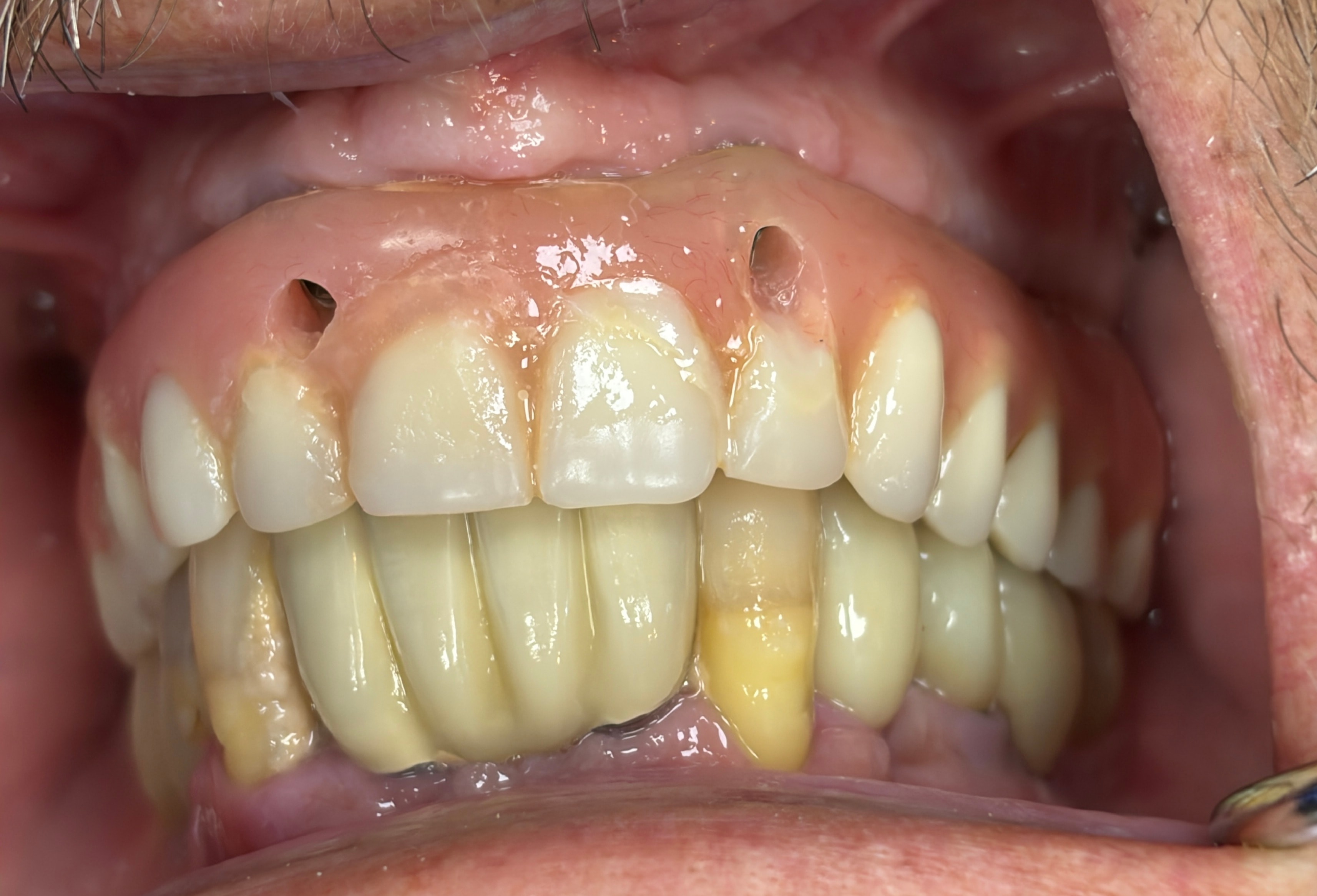 Unesthetic Upper All-on-4 because of wrong implant placement
