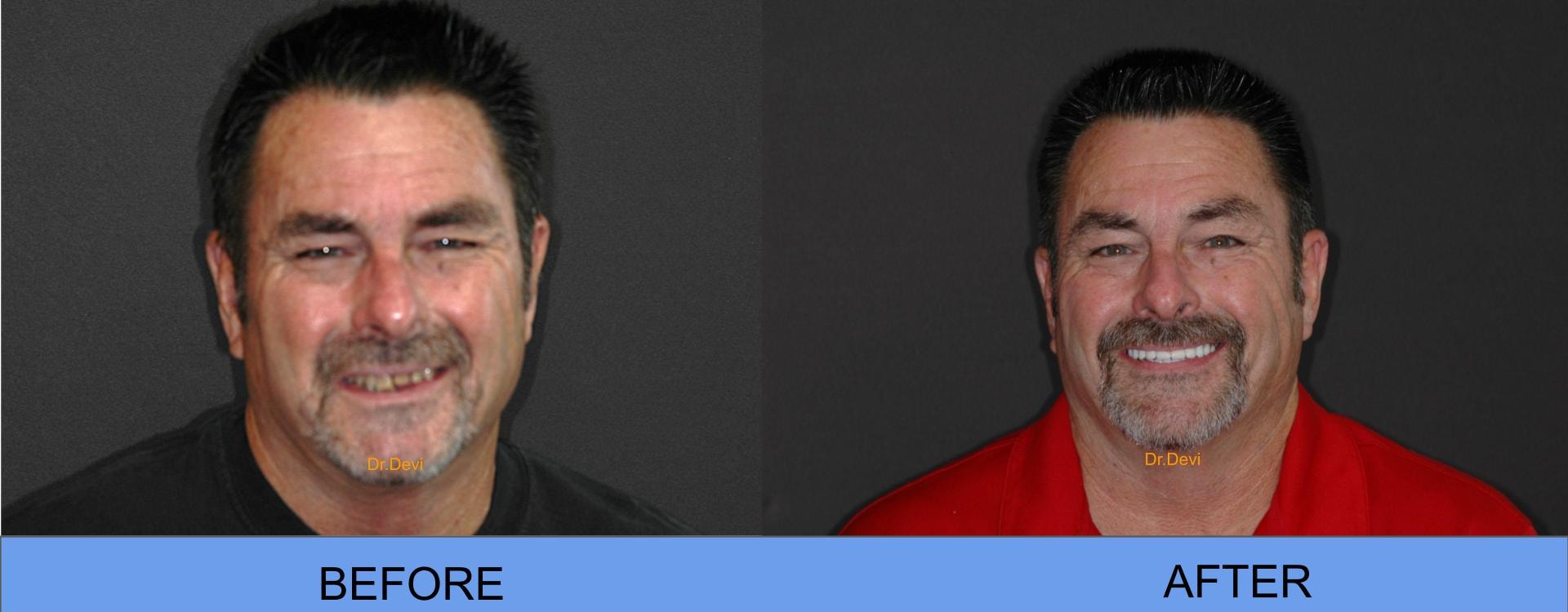 Patient smile transformation