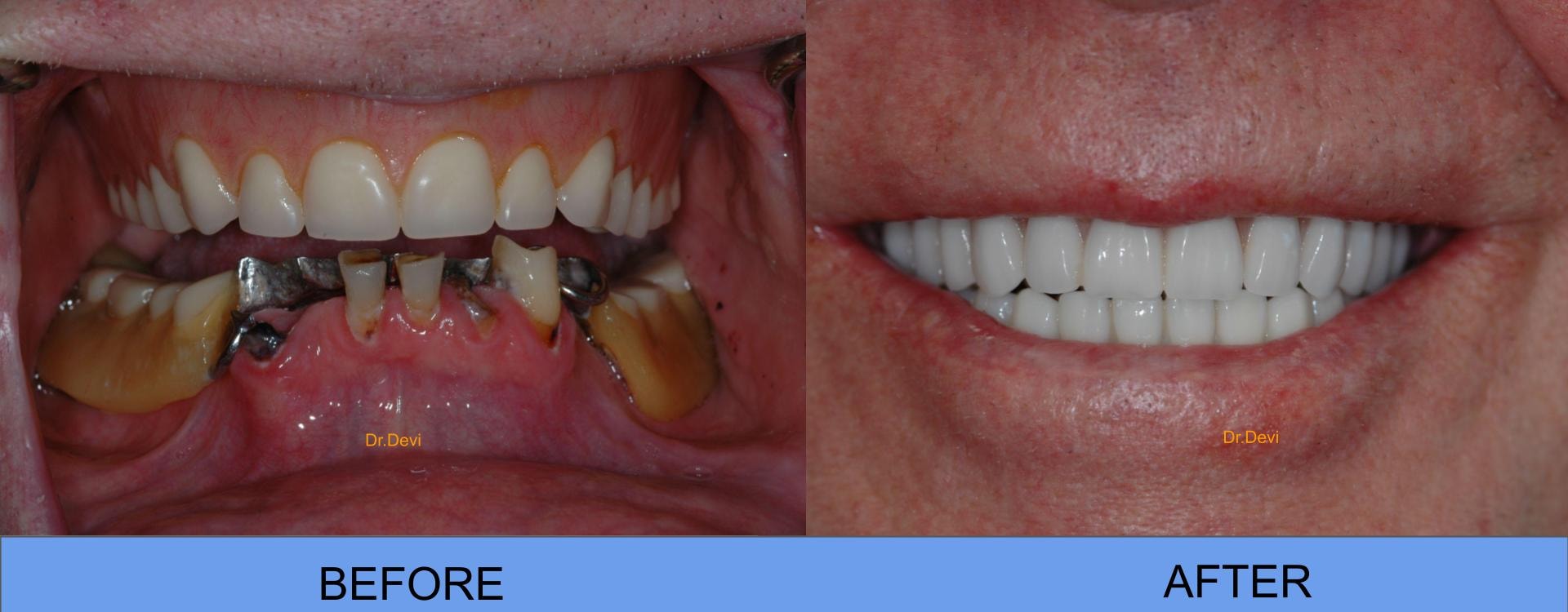 Patient smile transformation