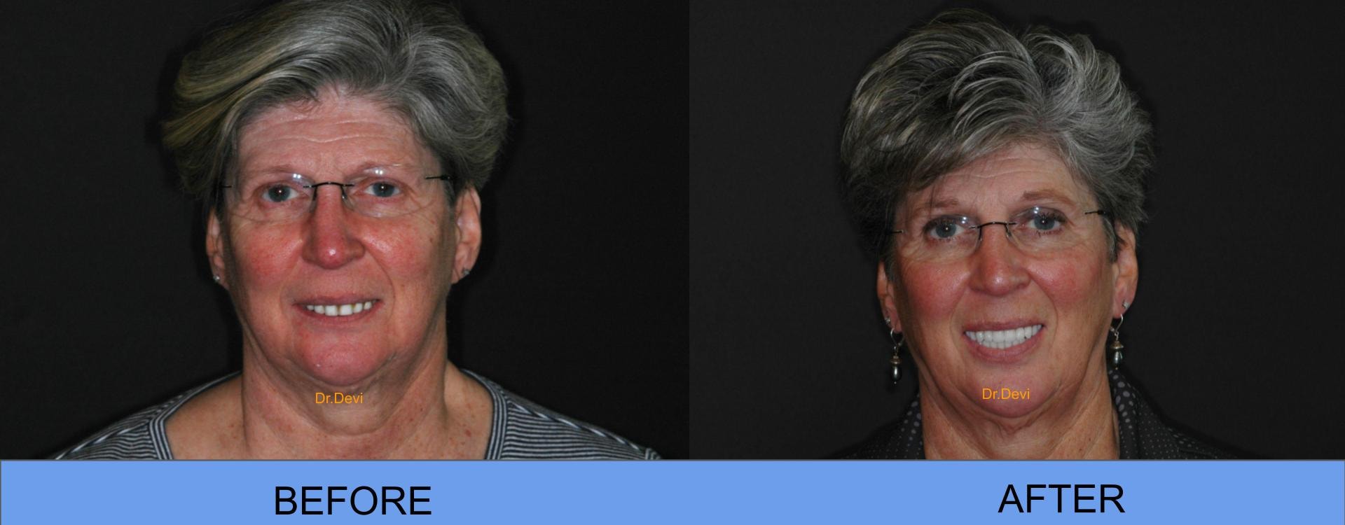 Patient smile transformation