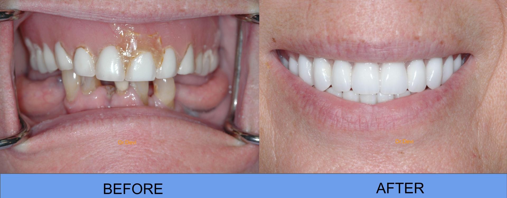 Patient smile transformation