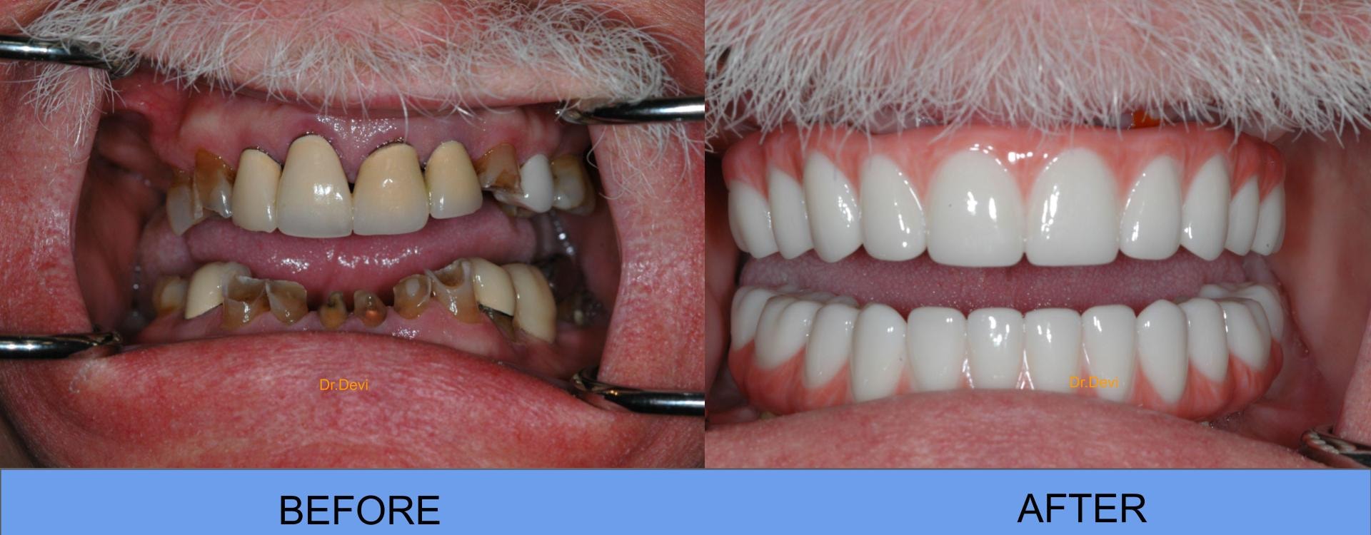 Patient smile transformation