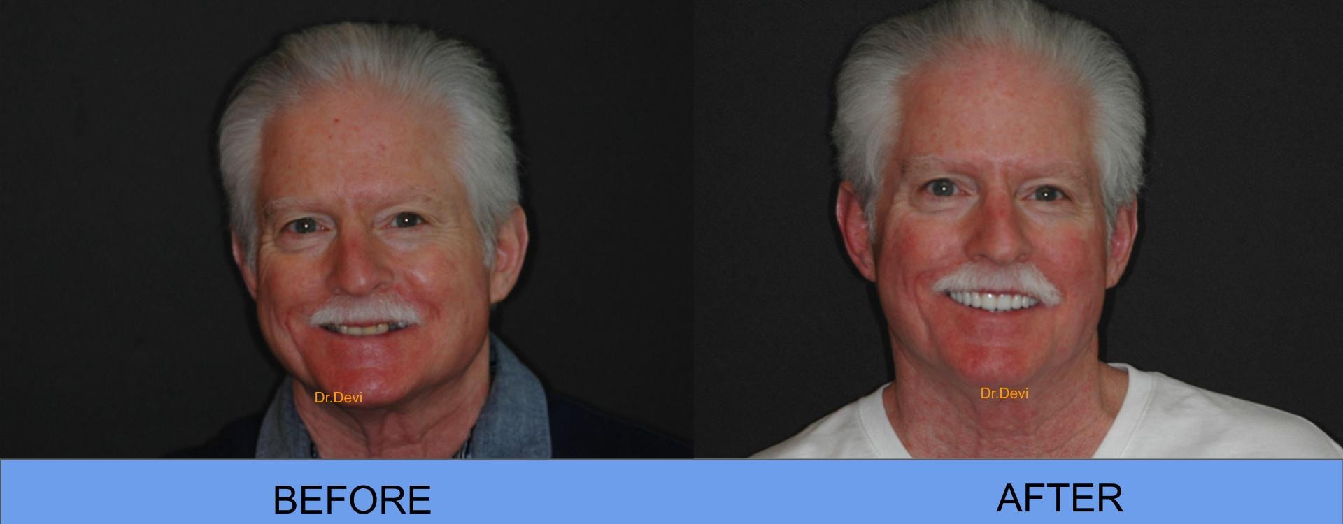 Patient smile transformation