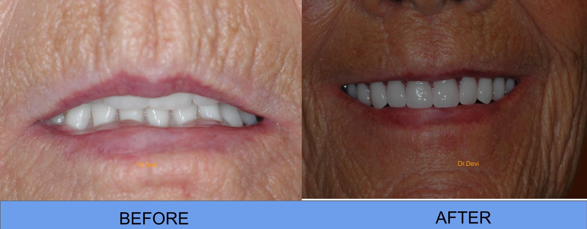Patient smile transformation
