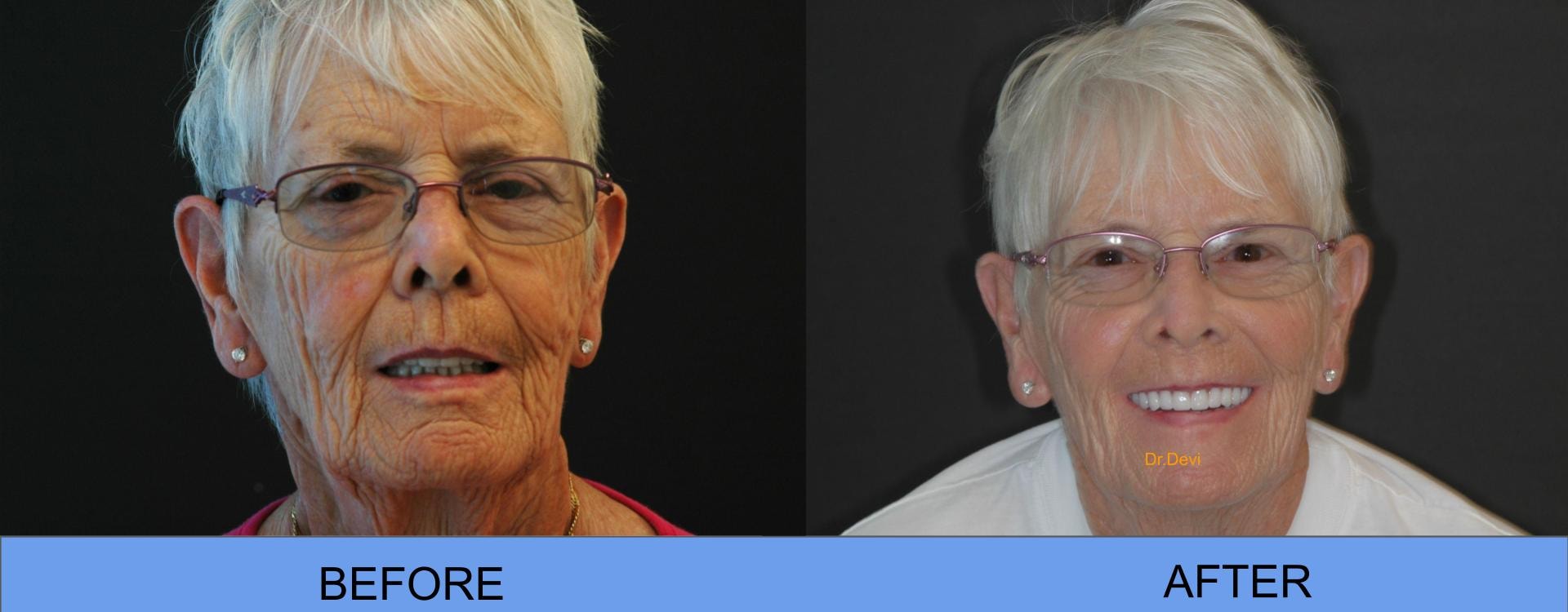Patient smile transformation