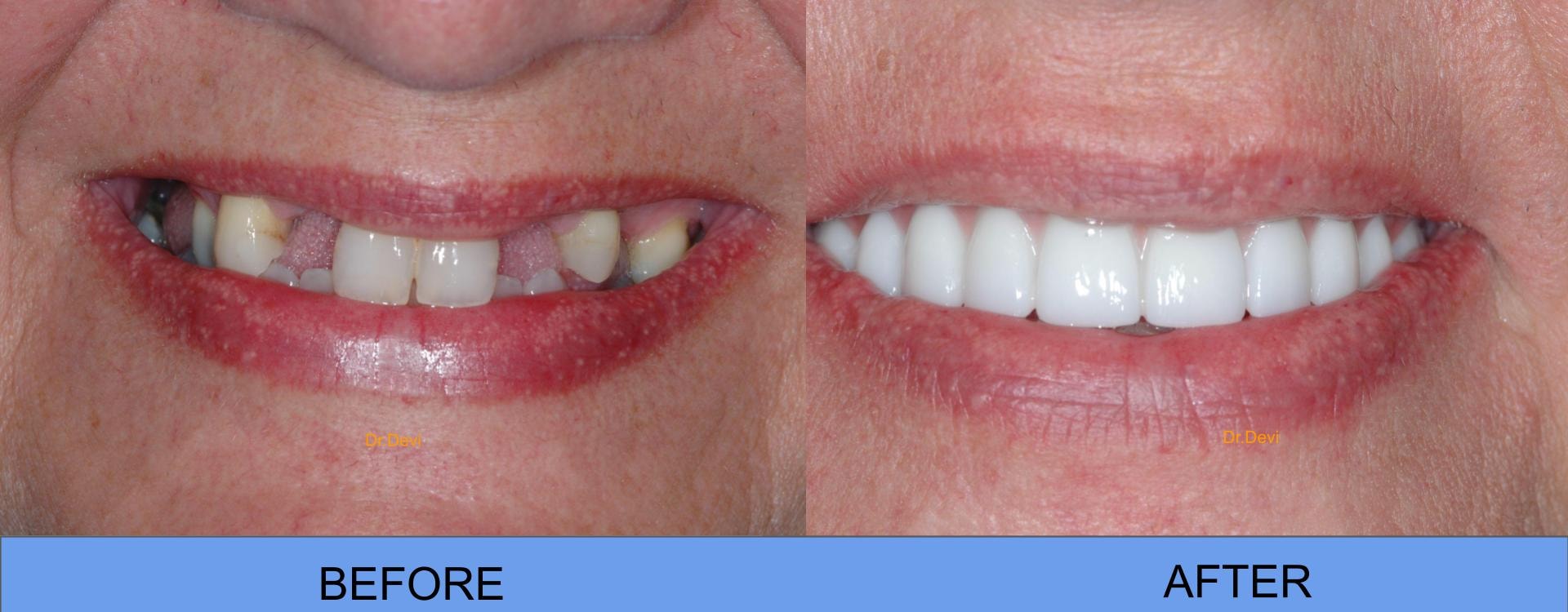 Patient smile transformation