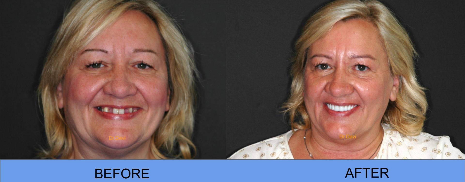 Patient smile transformation