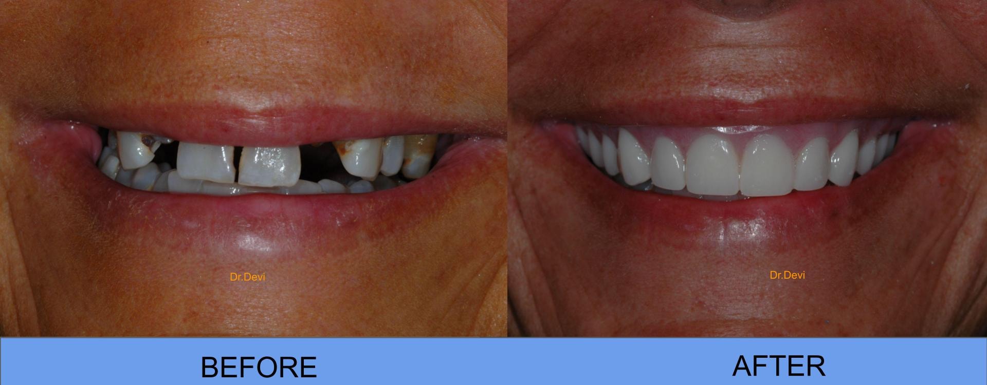 Patient smile transformation