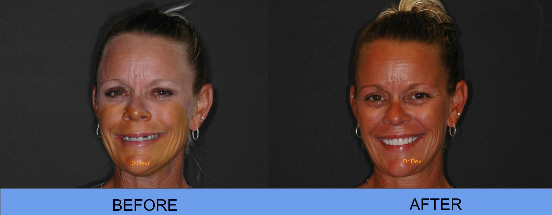 Patient smile transformation
