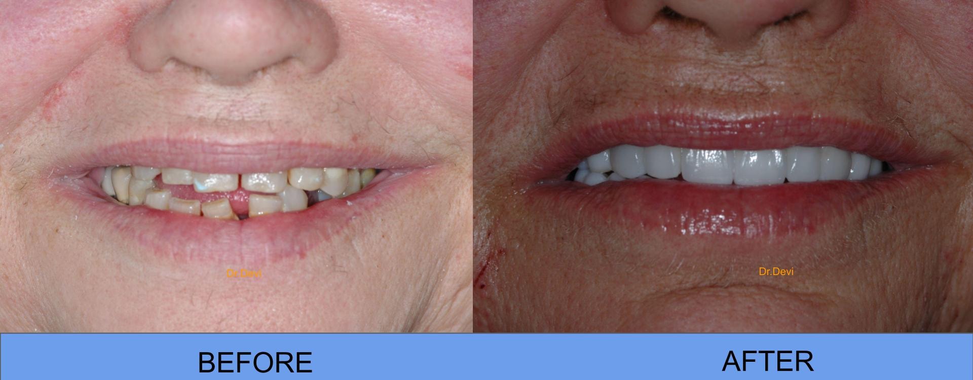 Patient smile transformation