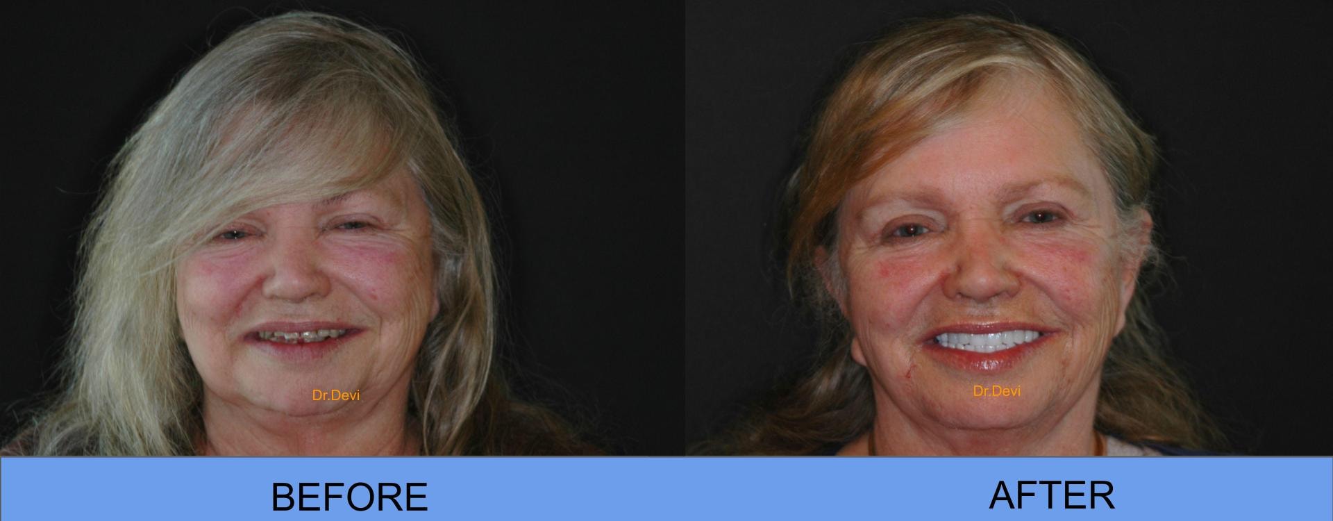 Patient smile transformation