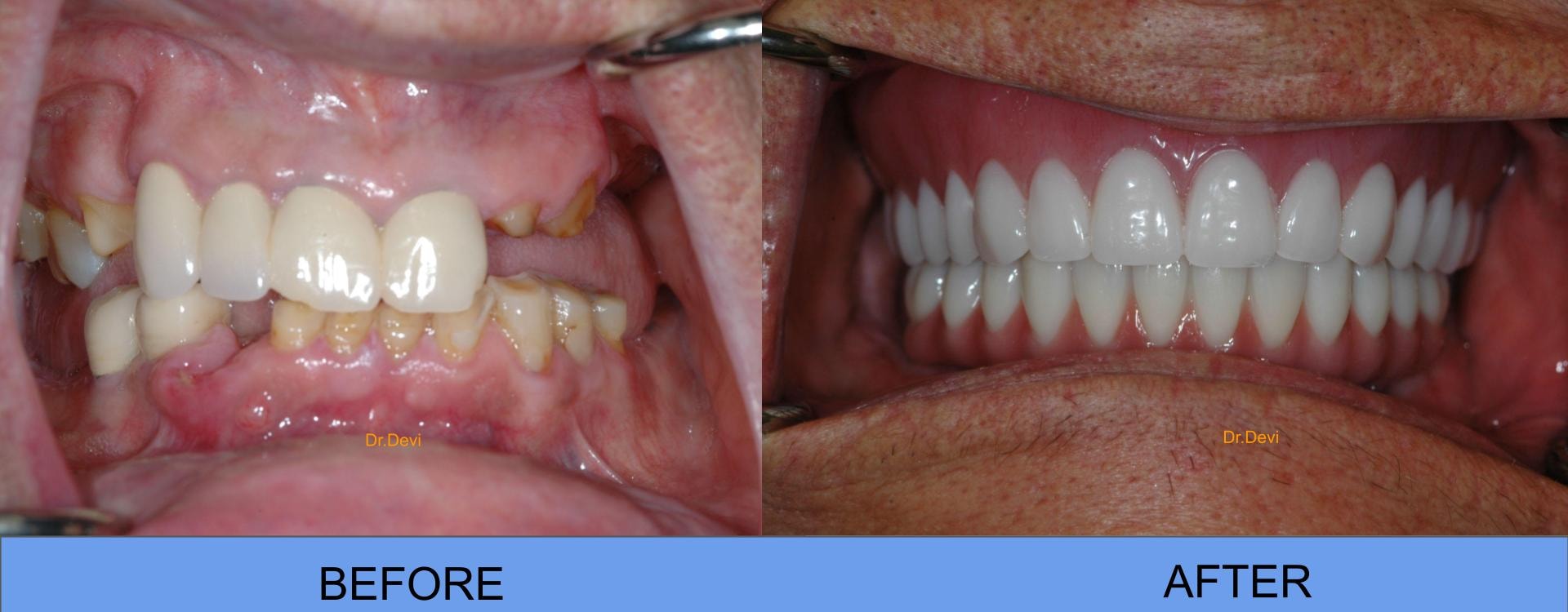 Patient smile transformation