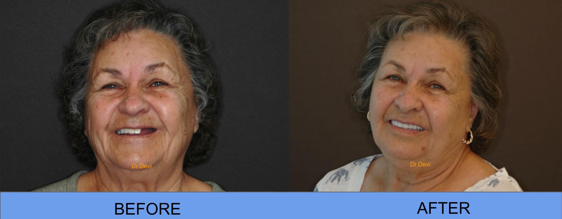 Patient smile transformation