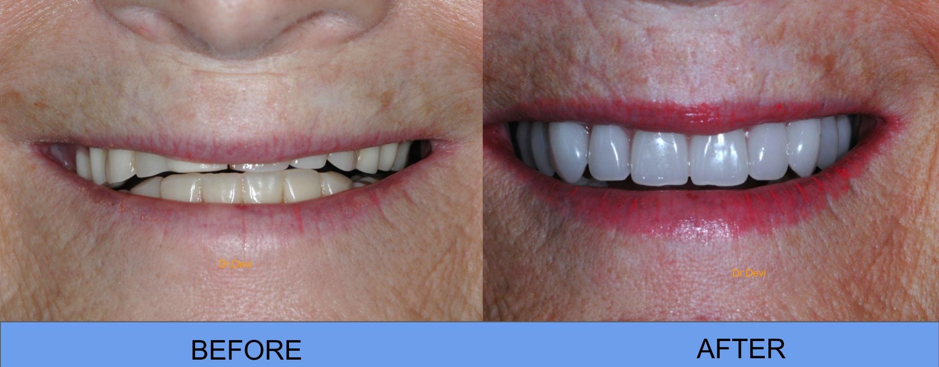 Patient smile transformation