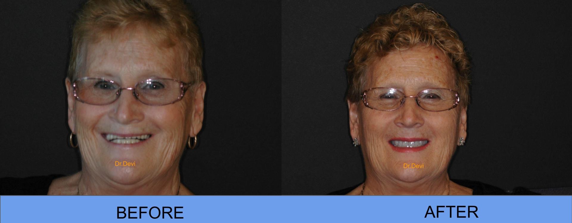 Patient smile transformation