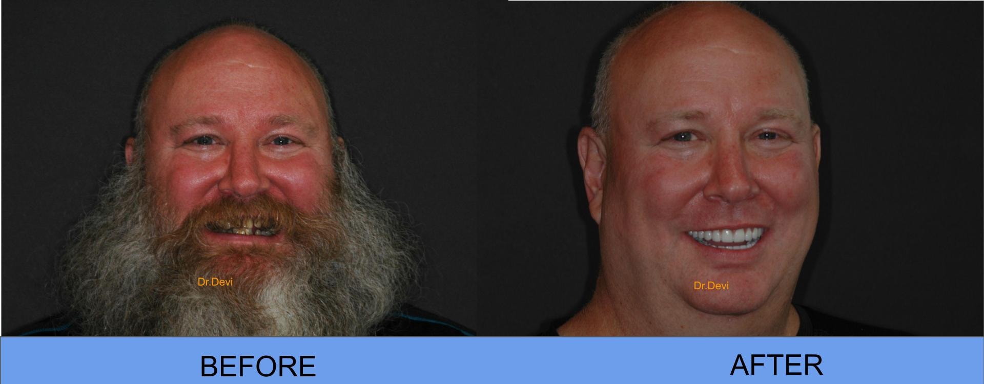 Patient smile transformation
