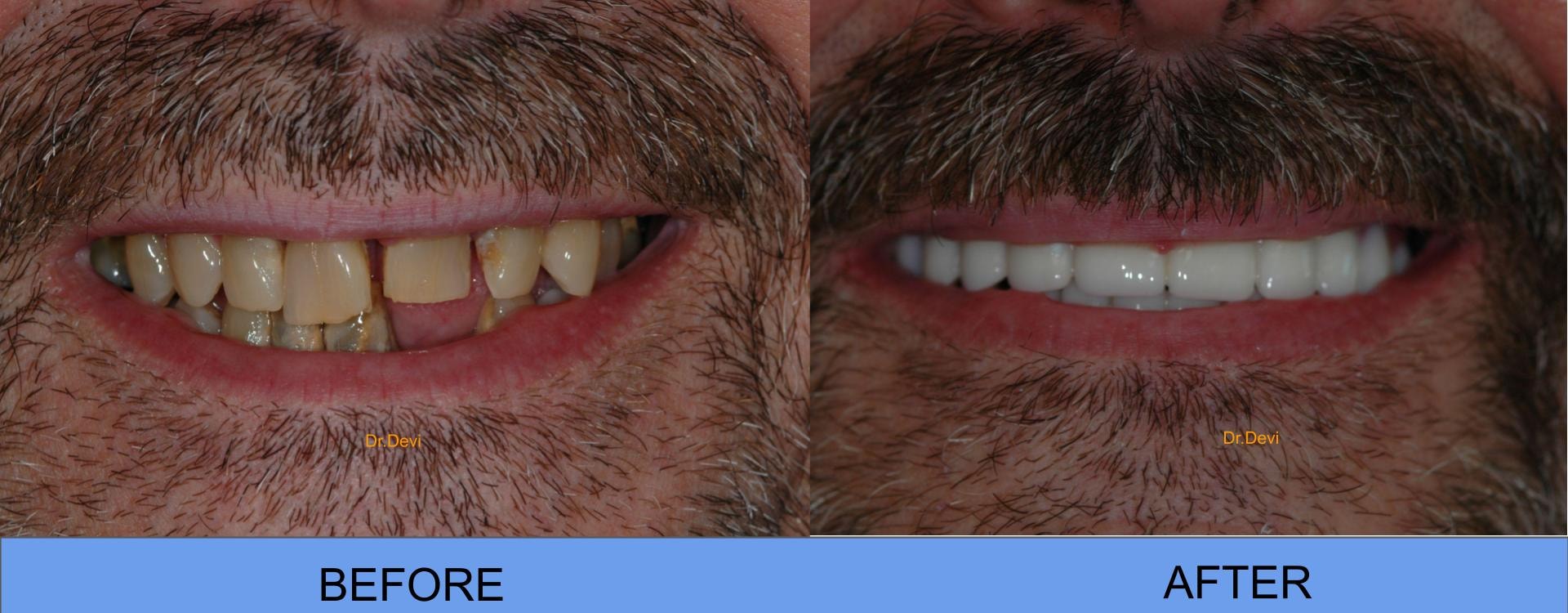 Patient smile transformation